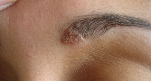 psoriasis-and-eczema-on-eyebrows-may-cause-them-to-itch