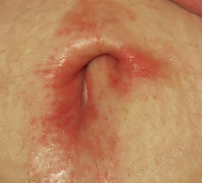 rash below belly button