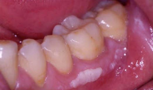 White Spots On Gums In Mouth 29