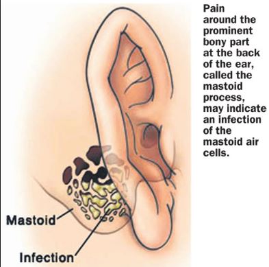 Image result for mastoiditis causes, symptoms & treatments