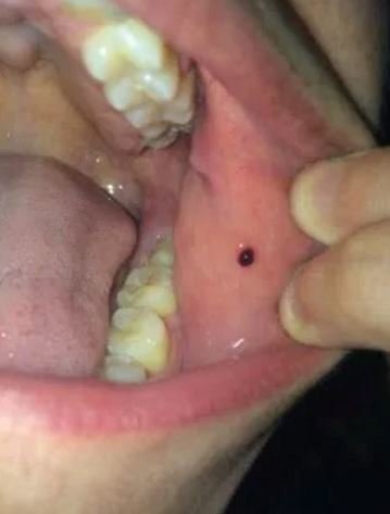 Black Spot In My Mouth 89