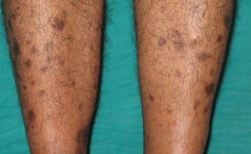 Brown spots on legs