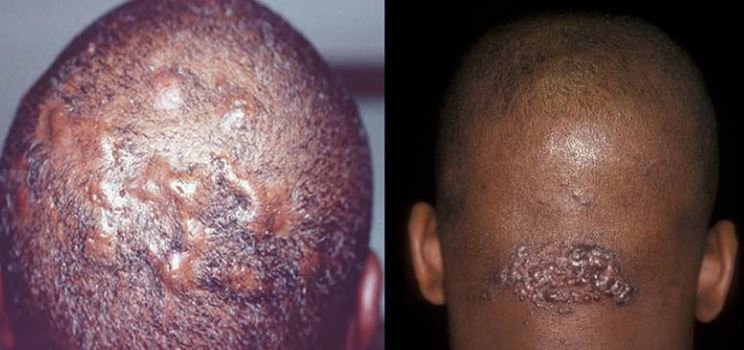 Severe ingrown hairs on the head can cause such bumps and scars