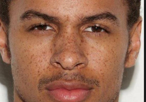 How to Remove Freckles Fast, Permanently Get Rid of 