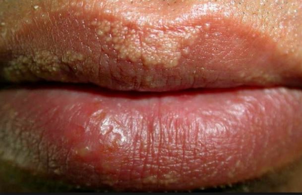Small Fordyce Spot on Lips, White, Yellowish Granules 