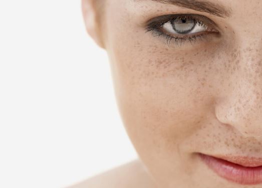 How To Remove Freckles Fast And Naturally How To Remove Freckles Fast And Naturally
