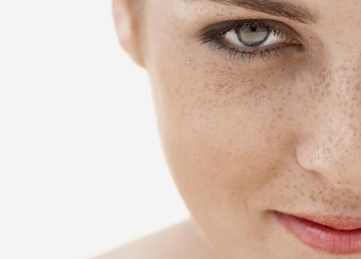 How to Remove Freckles Fast, Permanently Get Rid of 