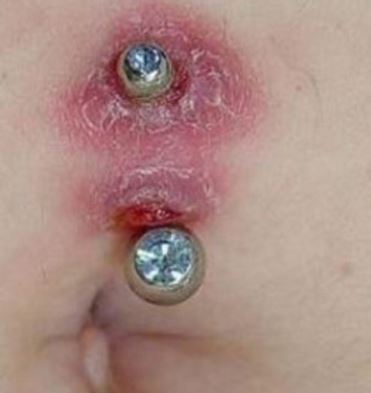 Infected navel piercing can turn itchy