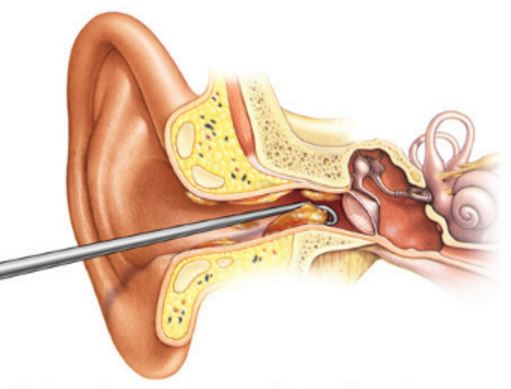 impacted-ear-wax-can-cause-itching