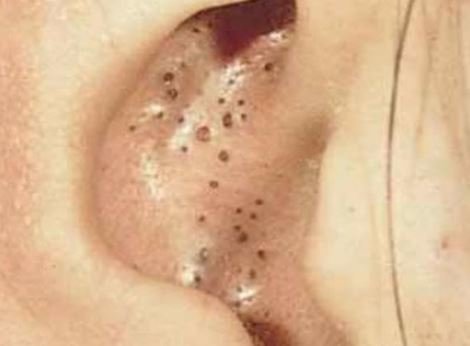 Blackheads in ear