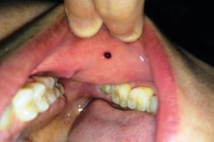 Small Blister In Mouth 45