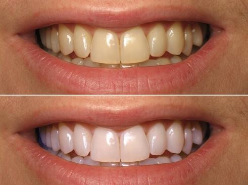 Turmeric powder for whiter teeth