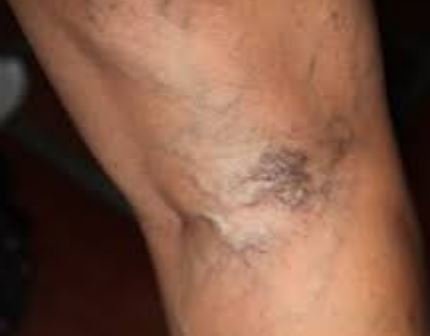 Blood clot behind knee due to varicose veins