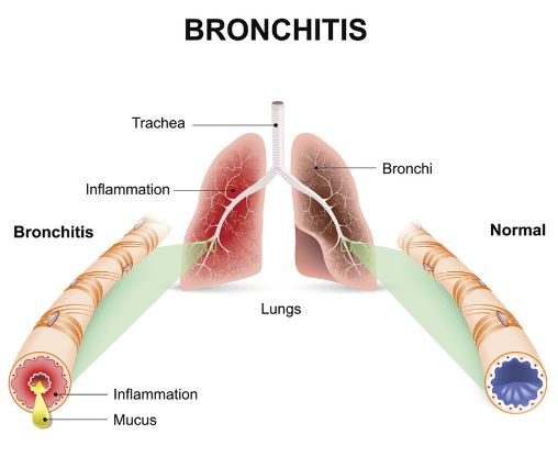 Bronchitis can lead to brown mucus in throat and chest