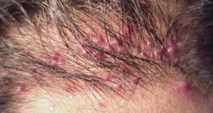 Folliculitis may also cause ingrown hair on your scalp