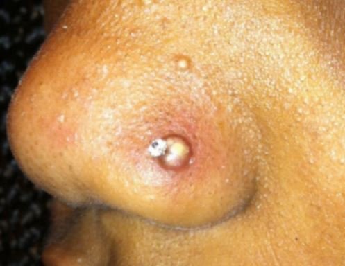 Infected nose piercing signs